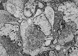 F,76y. | unspecified sarcoma (myocarcoma v.s.) - calf